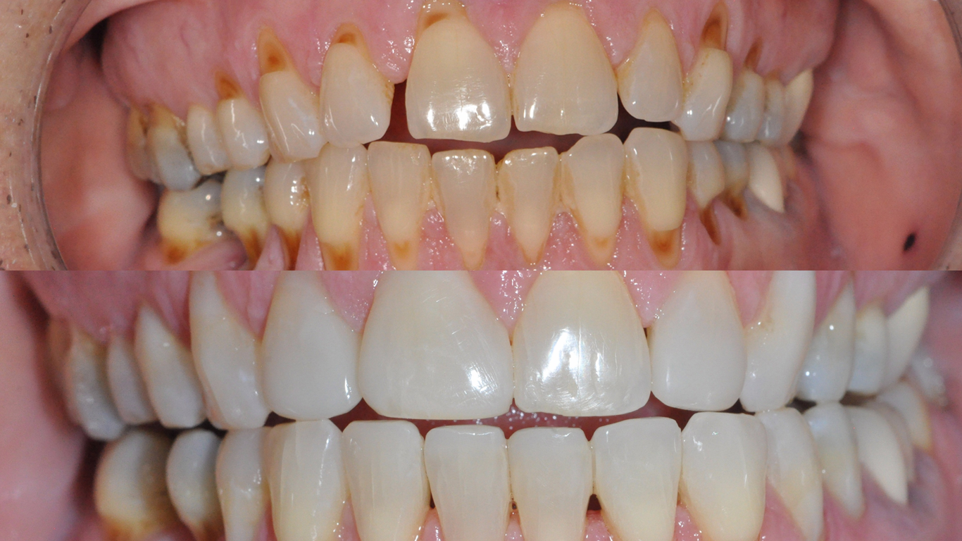 Before and After Bioclear