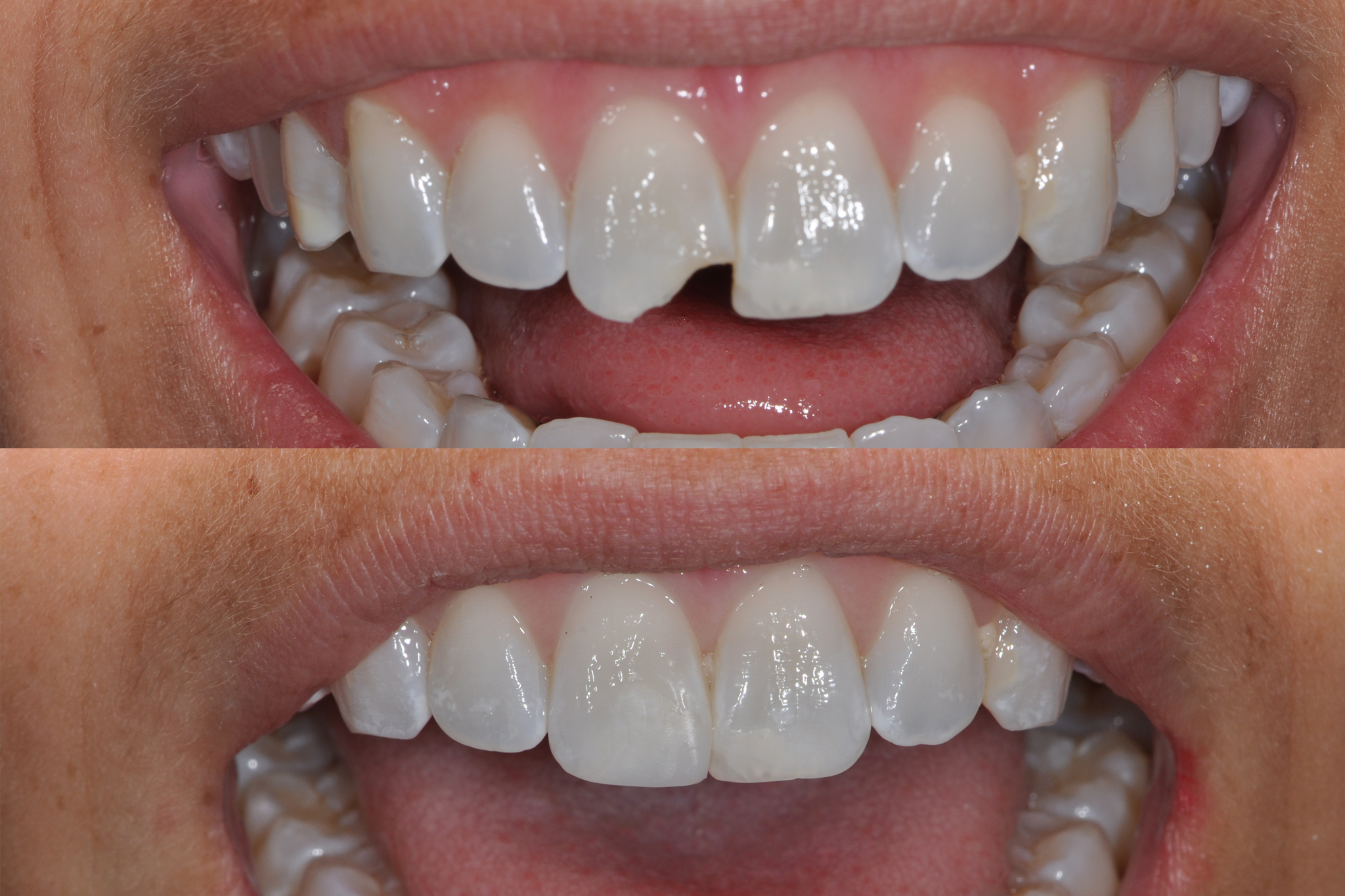 Before and After Composite Bonding