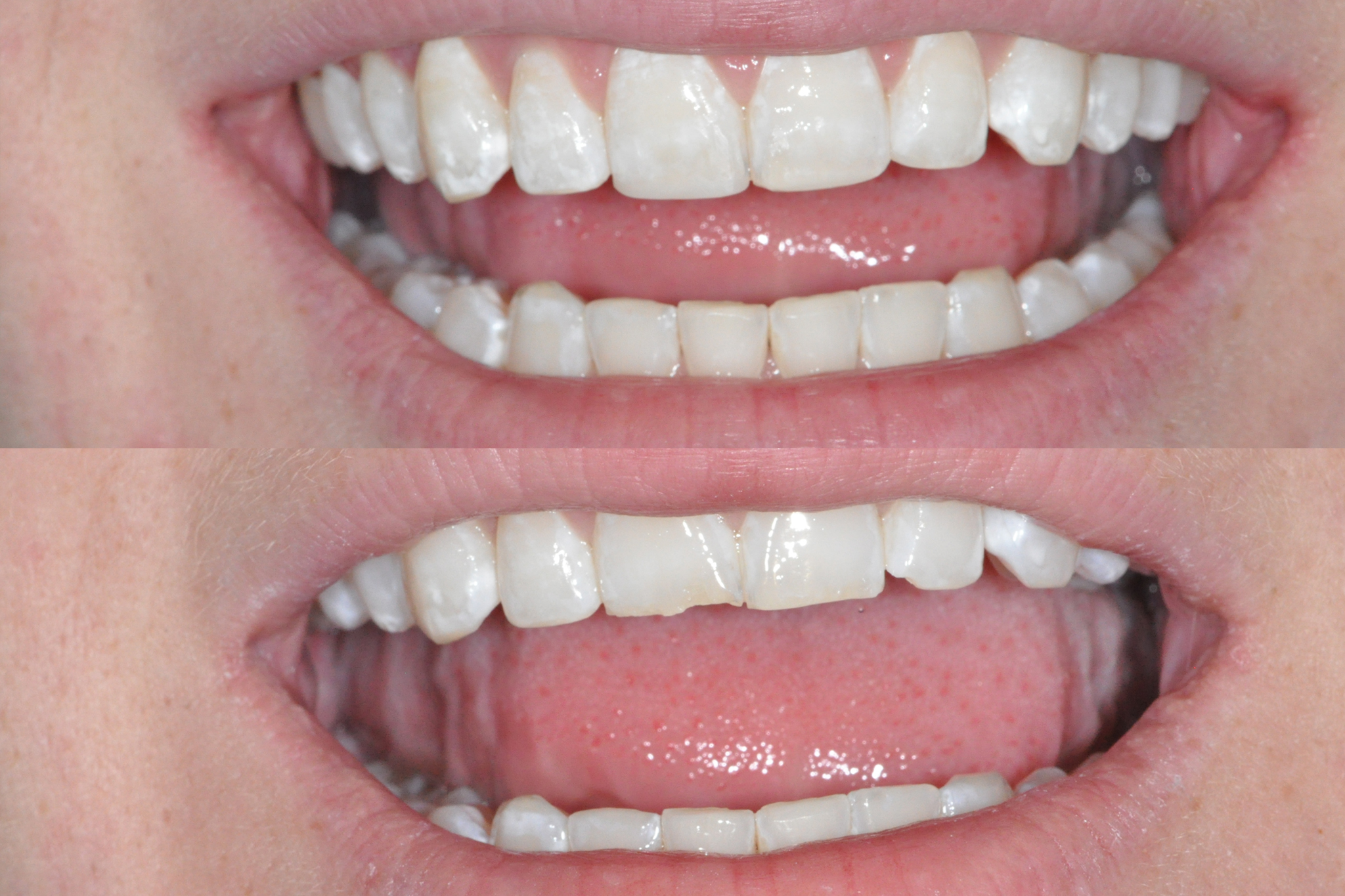 Before and After Mini Smile Makeover